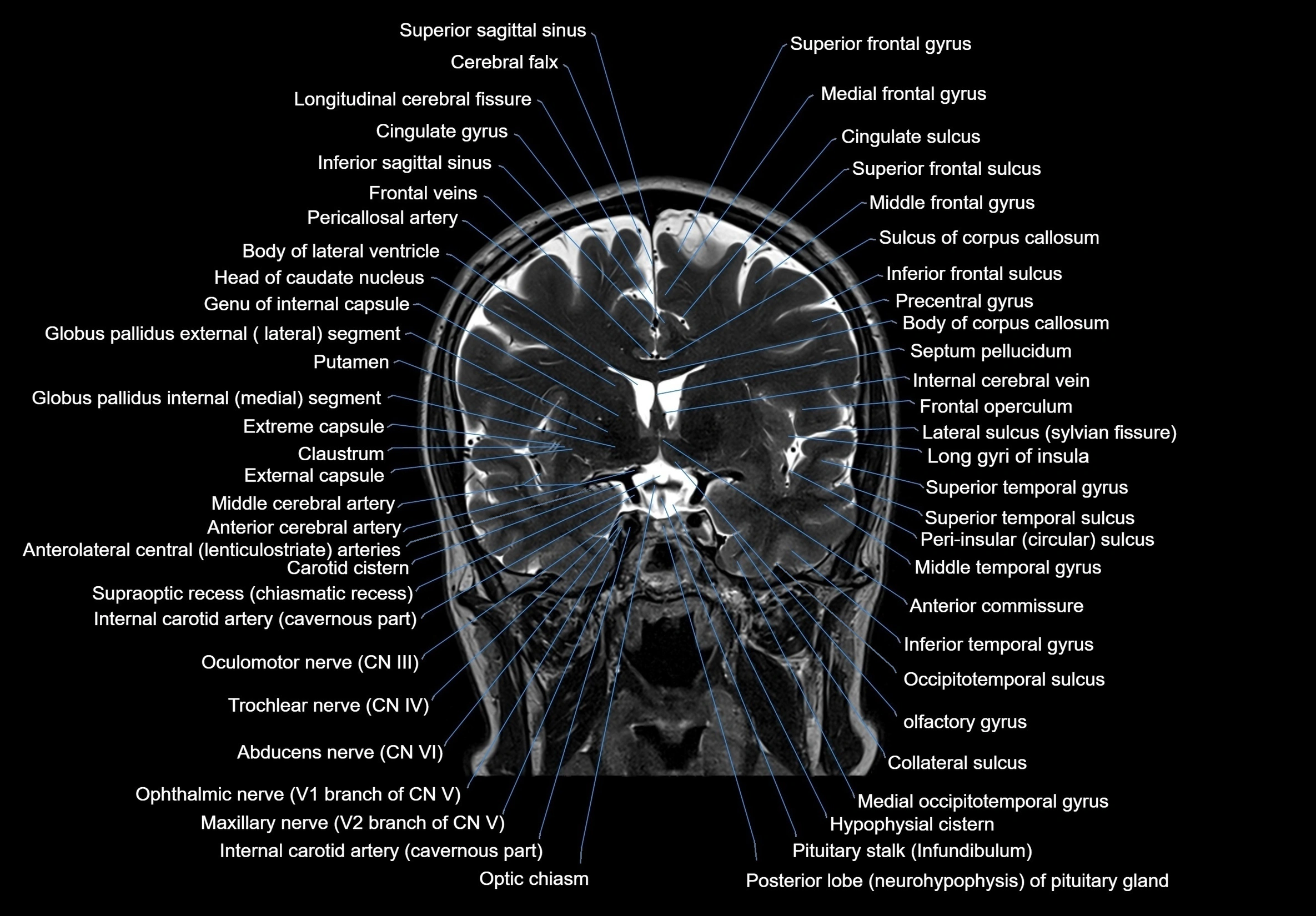 MRI Brain coronal cross sectional labelled anatomy 3T image  -img-00001-00032.webp